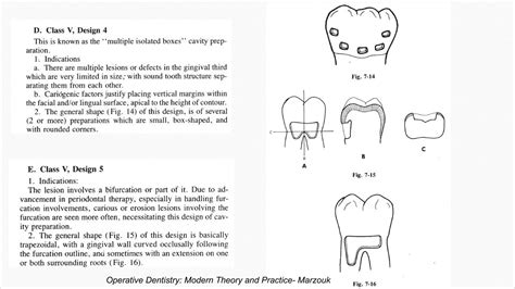 Class 5 Cavity Designs Ppt