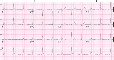 How To Read Abnormal Ecg Report - Printable Templates Protal