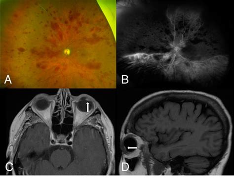 Figure 1 From Hemorrhagic Occlusive Retinal Vasculitis Leading To The