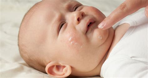 Baby Acne: What Are The Symptoms, Causes and Treatments? | My Baba