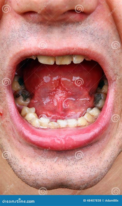 Amalgam Fillings Stock Images - Download 88 Royalty Free Photos