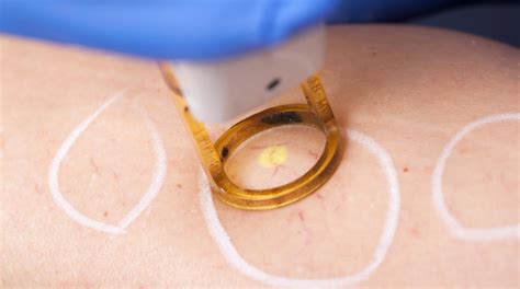 Types Of Laser Skin Treatments And What They Do