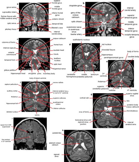 Normal Anatomy Of The Brain On Ct And Mri With A Few Normal Variants Practical Neurology