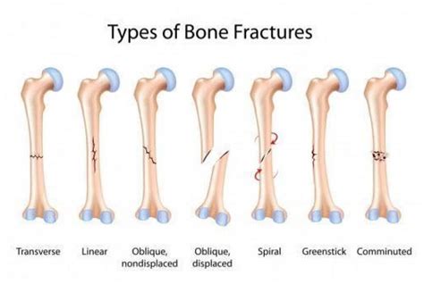 Types Of Long Bone Fractures