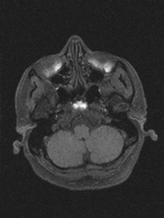 Acoustic Schwannoma Image Radiopaedia Org