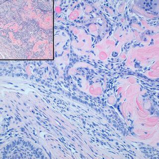 Transformation of the epithelial cells into ghost cells in the ...