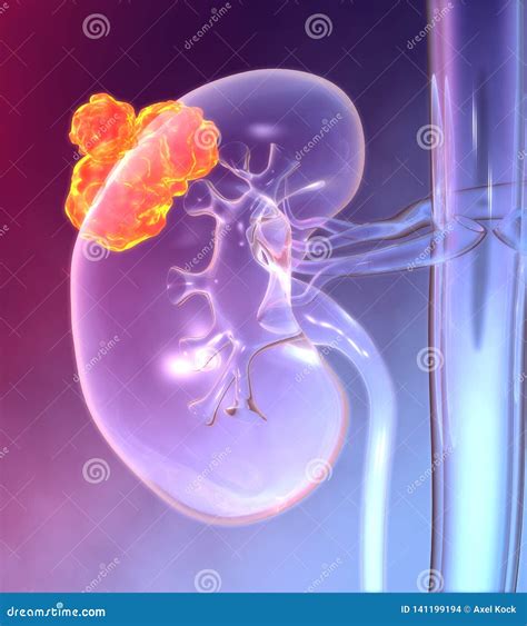 Kidney Cancer Colorful Medically 3d Illustration Stock Illustration