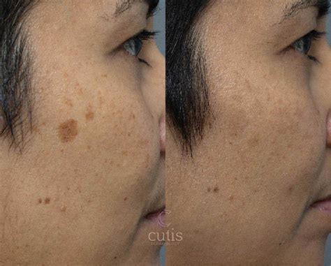 Picoway Laser Treatment Brisbane Cutis Dermatology