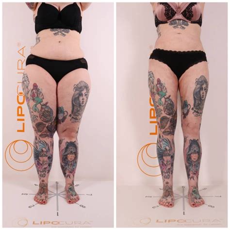 Lipedema Experiences Profile Of Diana Lipocura