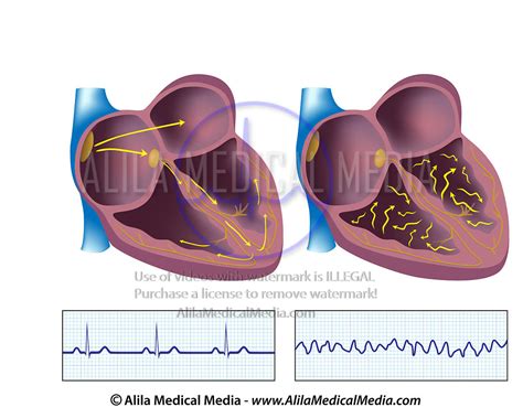 Alila Medical Media Ventricular Fibrillation V Fib Medical Animation