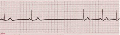 Junctional Escape Beat - EKG Lesson #314