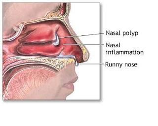 Healthy and Fit: Health Tips Facts - Sinus Polyps Symptoms Causes ...