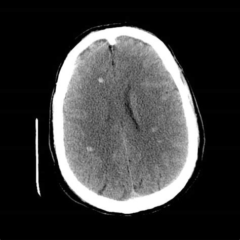 Diffuse axonal injury - wikidoc