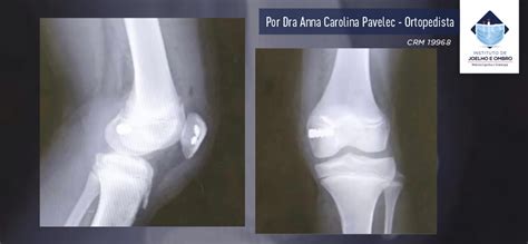 Luxa O Recidivante De Patela Ijo