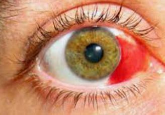 Blood Clot Under Eye