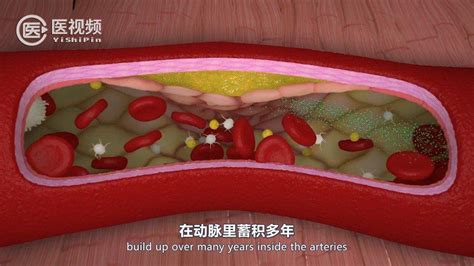 动脉粥样硬化和心血管疾病 精彩的医学动画向你演示动脉粥样硬化新浪新闻