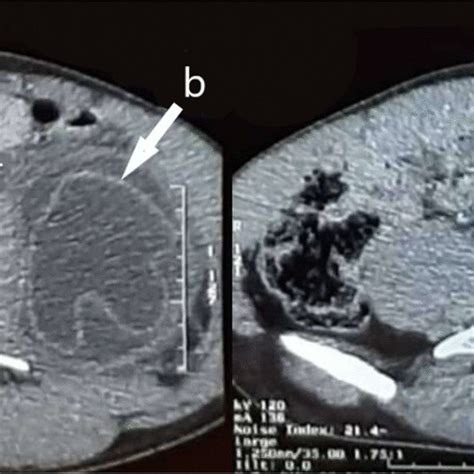 Computed Tomography Scan Image Showing Hydatid Cyst A With Detached Download Scientific