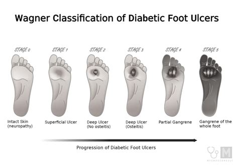 Diabetic Foot Ulcer Stages – A Concise Guide – My Endo Consult