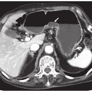 Abdominal Contrast Enhanced Computed Tomography Showing Cystic Lesions