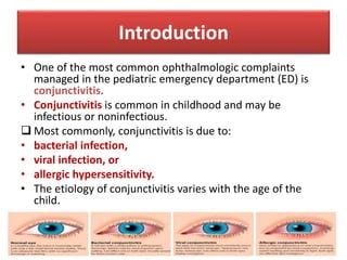 Diagnosis And Management Of Pediatric Conjunctivitis Ppt