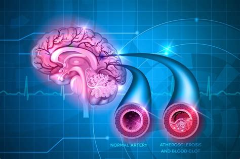 Lancet Neurol Medsci Cn