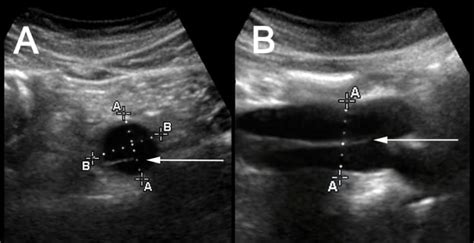 Aortic Dissection Ultrasound