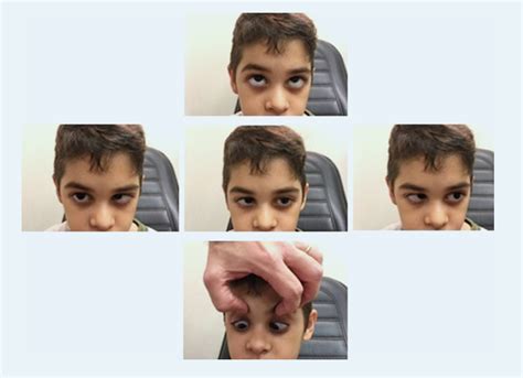 Figure 1 from BILATERAL ABDUCENS NERVE PALSY SECUNDARY TO INTRACRANIAL SINUSES THROMBOSIS IN A ...