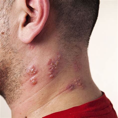 Shingles Rash Blisters