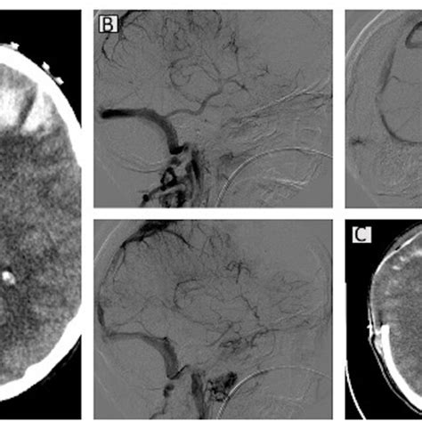 Computed tomography (CT) scans for case 2. A brain CT scan showed ...