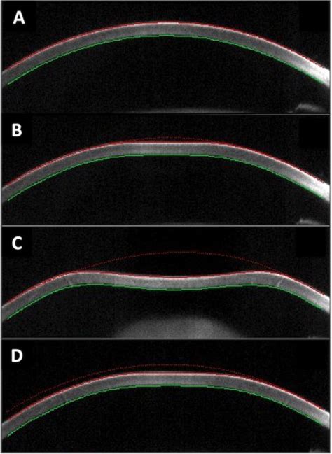 Corneal Biomechanical Properties Are Associated With The Activity And