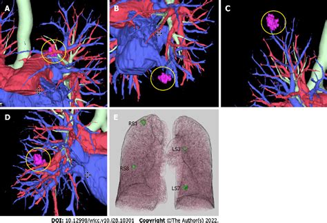 Figure 1 From One Stage Resection Of Four Genotypes Of Bilateral Multiple Primary Lung