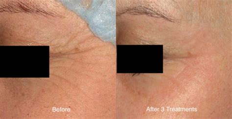 Laser Treatment For Crows Feet Before And After Photo Gentle Touch