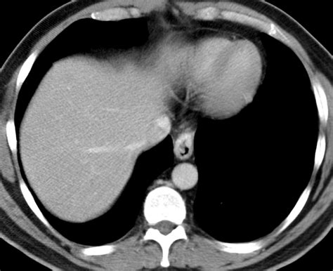 Anatomic And Functional Imaging Of Metastatic Carcinoid Tumors