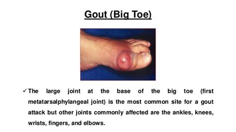 Symptoms of gout