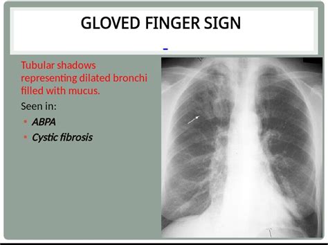 Chest Medicine Made Easy Dr Deepu Gloved Finger Sign