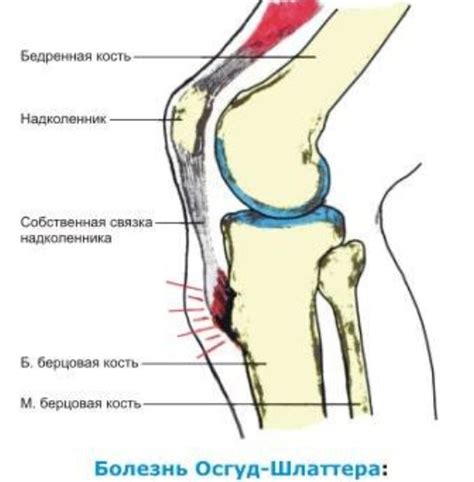 Болезнь Осгуда-Шляттера - НЦЗД
