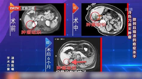 大医生：冷热刀消灭肿瘤，微创且精准的癌症杀手 北京时间