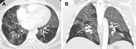 Mosaic Attenuation Pattern Radiologic Clinics