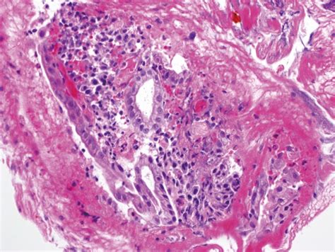 Biopsy Specimen Of Mucosal Hyperplasia Showing Inflammatory Bile Duct