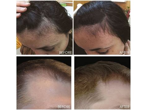 Hair Loss And Restoration Solutions — Ici Paris Skin Clinic Spa