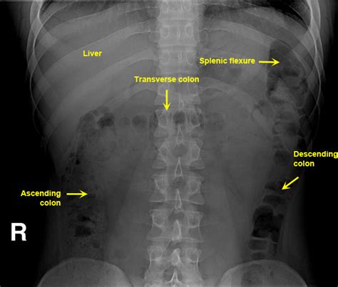 Labeled Abdominal X Ray