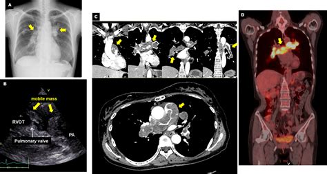 Visualization Of Pulmonary Artery Intimal Sarcoma By Color Coded Iodine