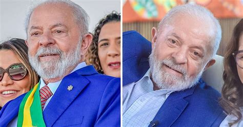 Veja Antes E Depois De Lula Ap S Cirurgia Pl Stica