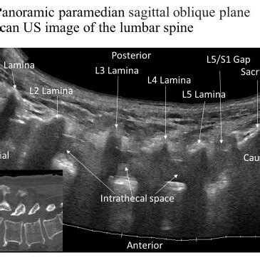 Panoramic Paramedian Sagittal Oblique Sonogram Of The Lumbar And