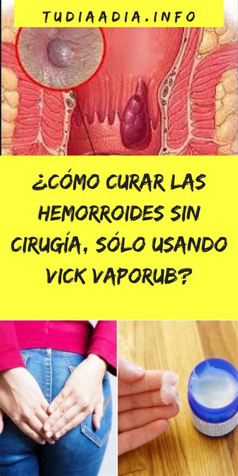 ¿cómo Curar Las Hemorroides Sin Cirugía Sólo Usando Vick Vaporub