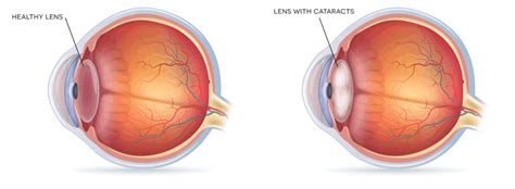 Cataract Naveen Eye Hospital