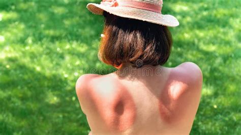 Sunburn On The Back And Neck Of A Man Skin Peeling And Peeling Red