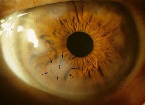 Ocular Pathology Salzmanns Nodular Degeneration Of The Cornea Eye