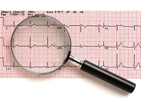 Comprendre les résultats de votre electrocardiogramme Soignez vous