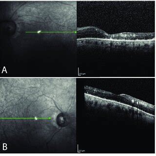 B Scan Structural Optical Coherence Tomography Showing Diffuse Atrophy